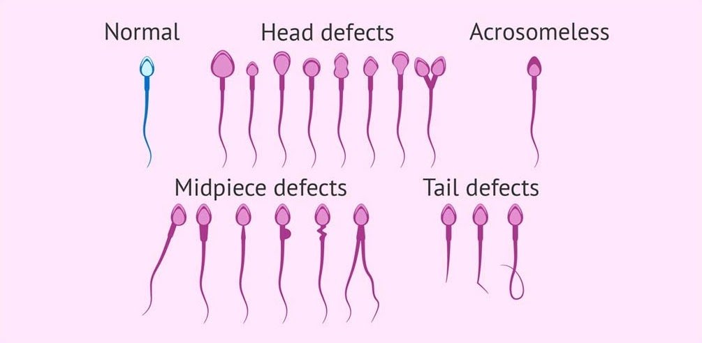 What Is Sperm Morphology And How Does It Affect Male Fertility